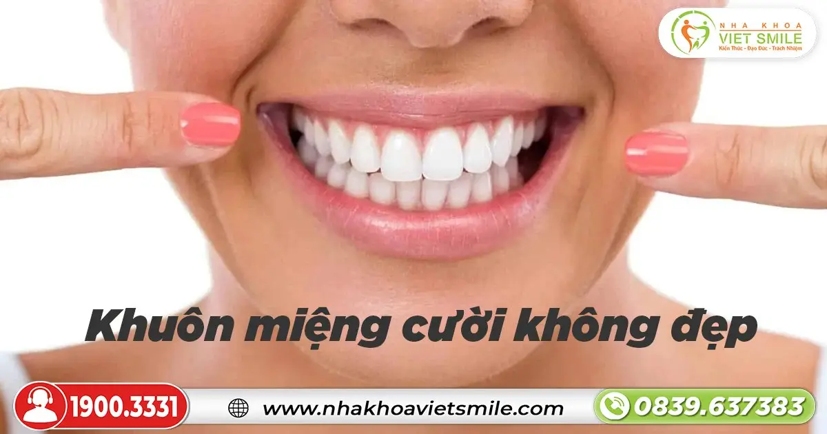 khuon mieng cuoi khong dep