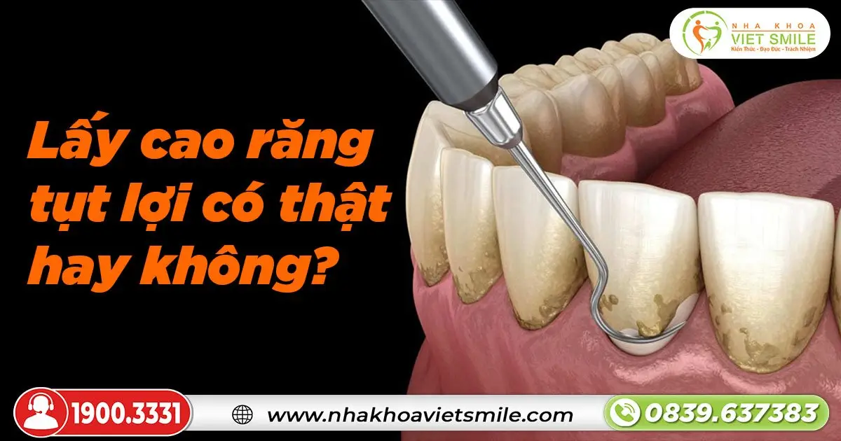 Lấy cao răng tụt lợi có thật hay không?