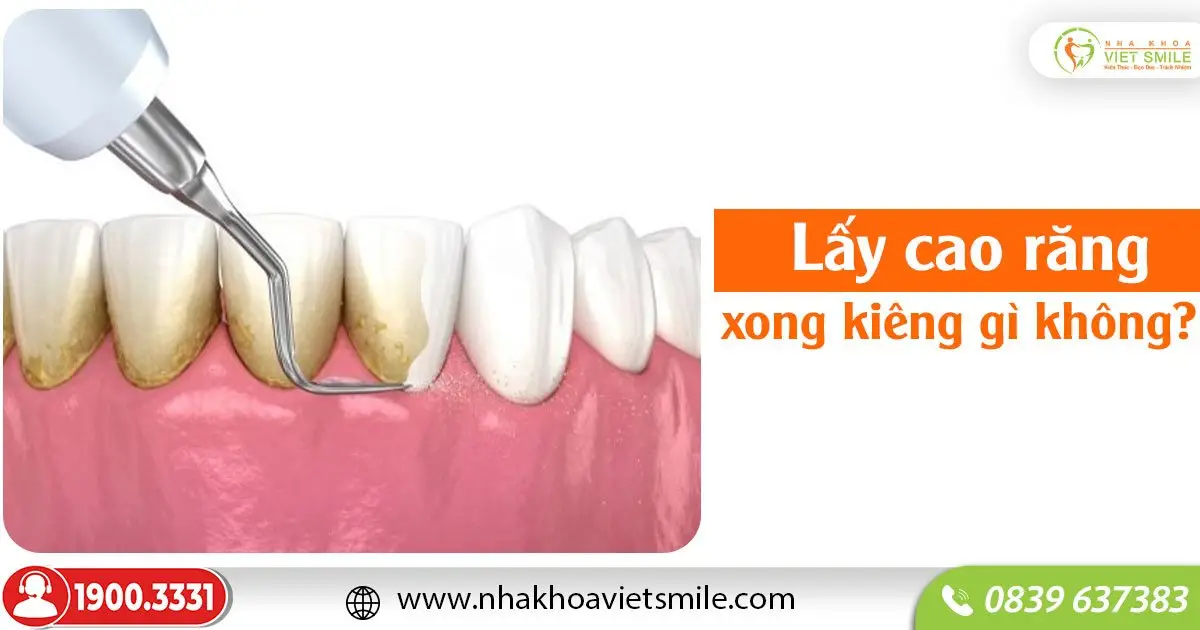 Lấy cao răng xong kiêng gì không?
