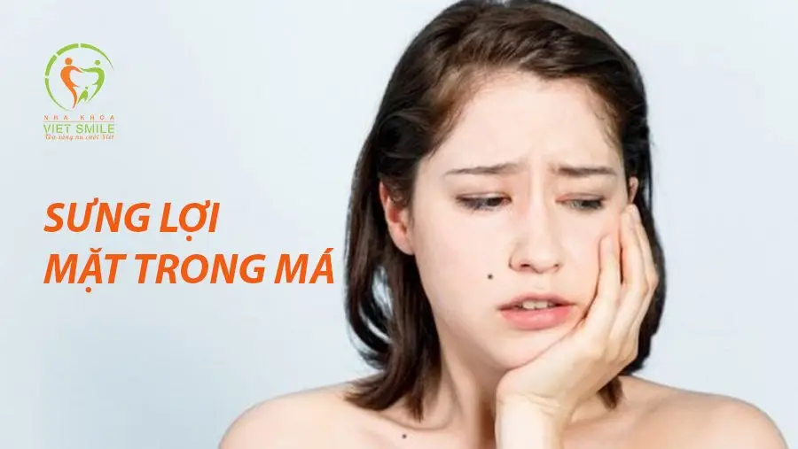 Mặt trong má bị sưng