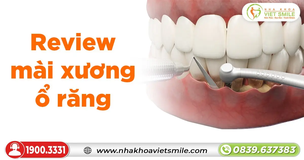 Review mài xương ổ răng