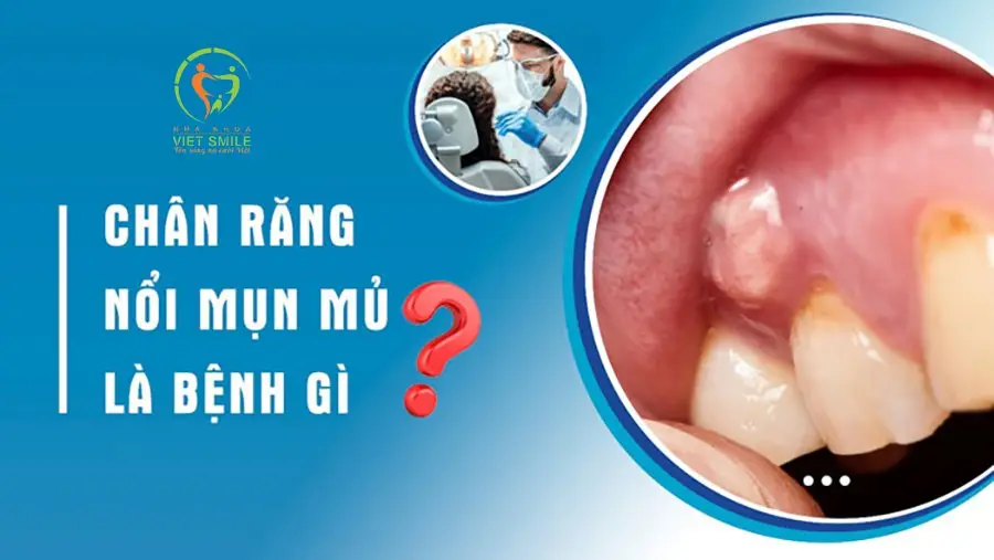 Bệnh mủ chân răng