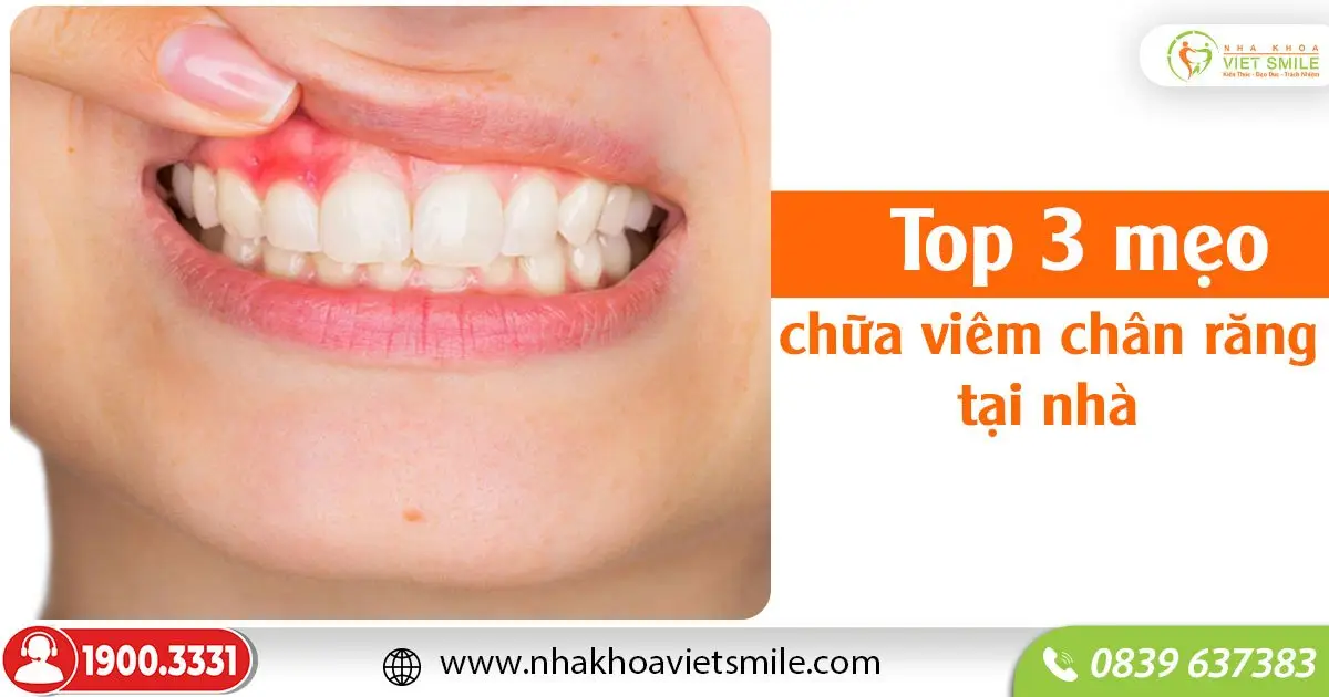 Top 3 mẹo chữa viêm chân răng tại nhà!