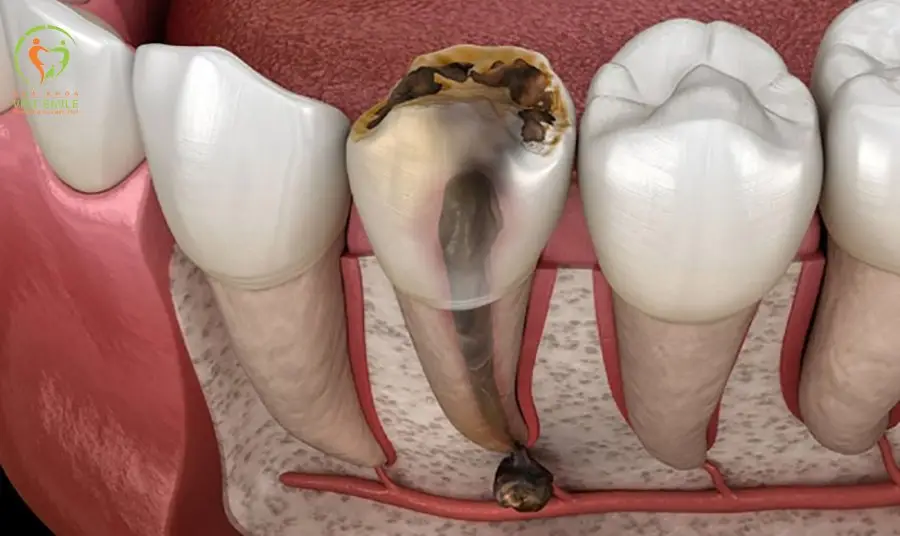 Nguyên nhân gây ra ung thư tủy răng