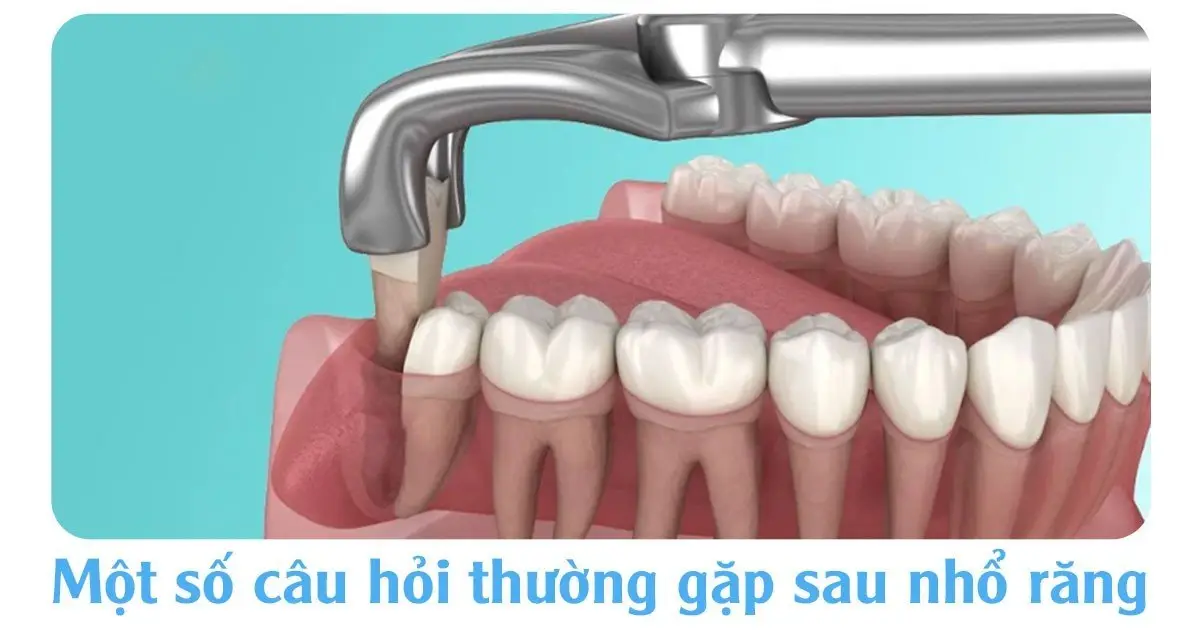 Nhổ răng lúc nào là tốt nhất cho sức khỏe?