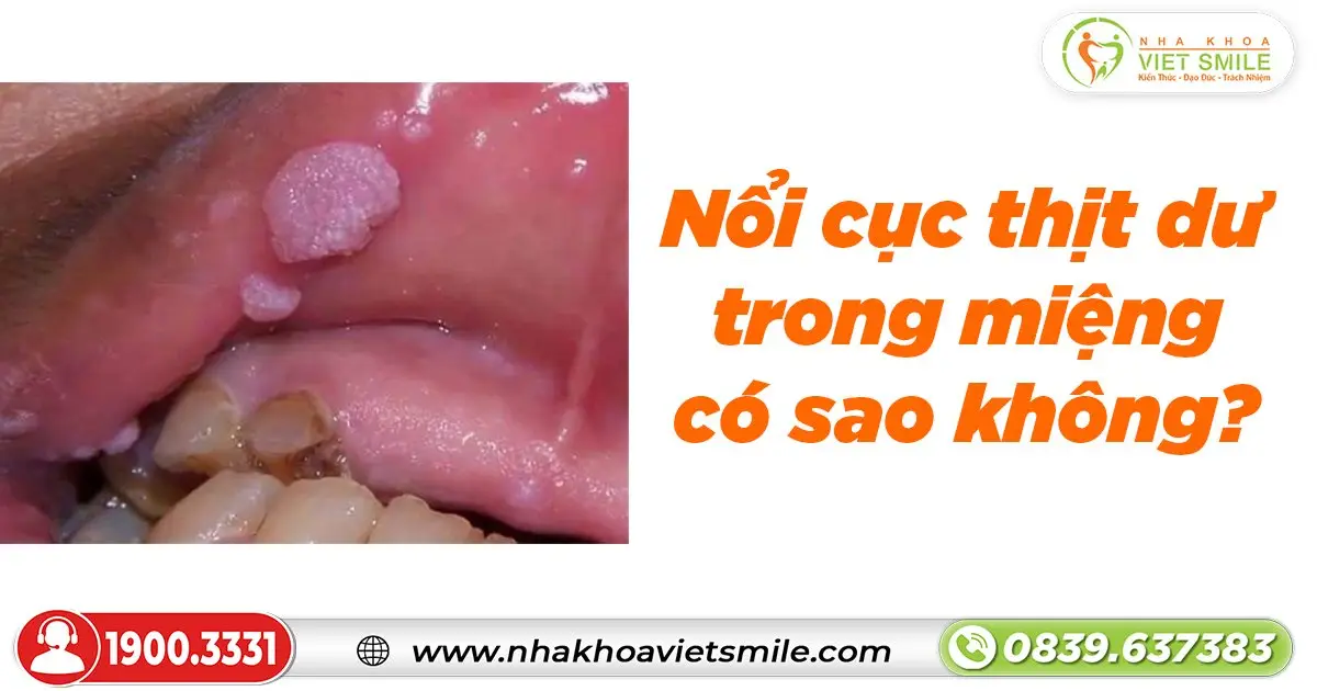 Nổi cục thịt dư trong miệng có sao không?