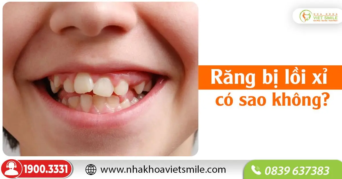 Răng bị lồi xỉ có sao không?