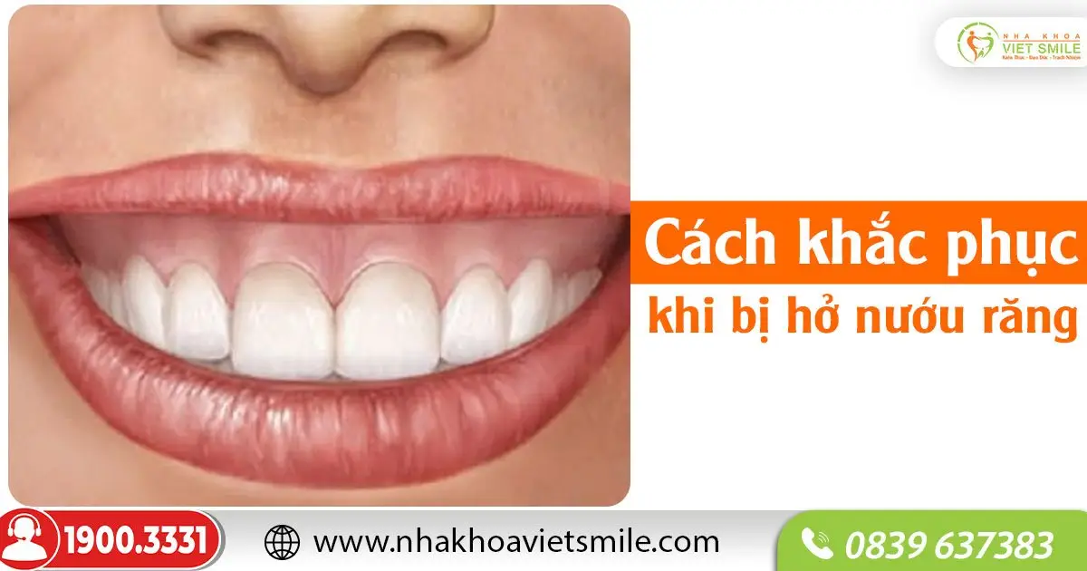 Cách khắc phục khi bị hở nướu răng