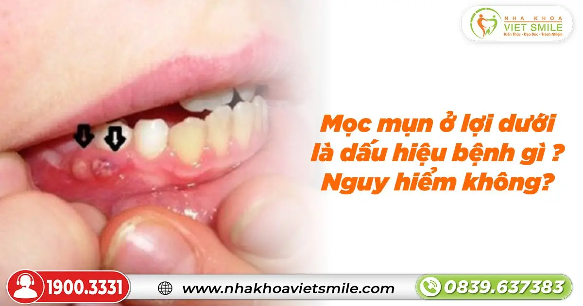 Mọc mụn ở lợi dưới là dấu hiệu bệnh gì? Nguy hiểm không?