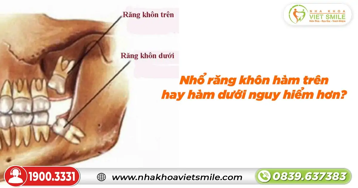 Nhổ răng khôn hàm trên hay hàm dưới nguy hiểm hơn?