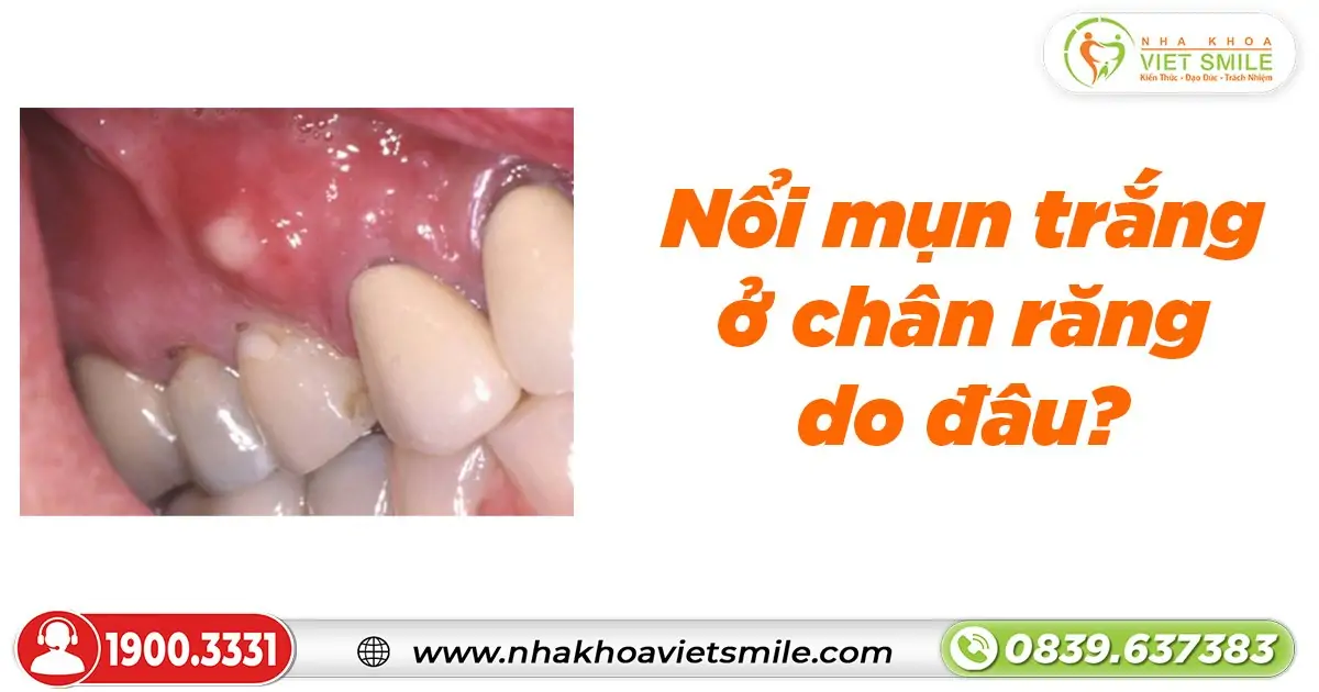 Nổi mụn trắng ở chân răng do đâu?