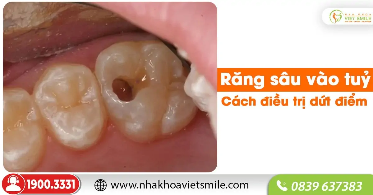Răng sâu vào tuỷ - Cách điều trị dứt điểm