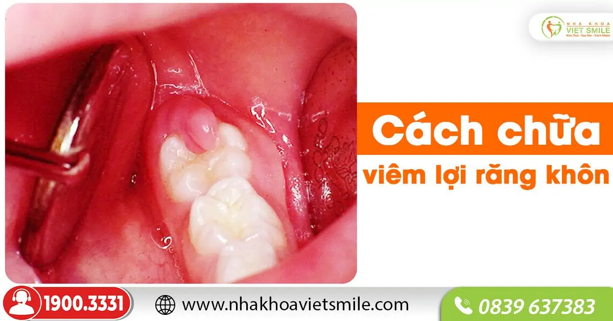 Cách chữa viêm lợi răng khôn