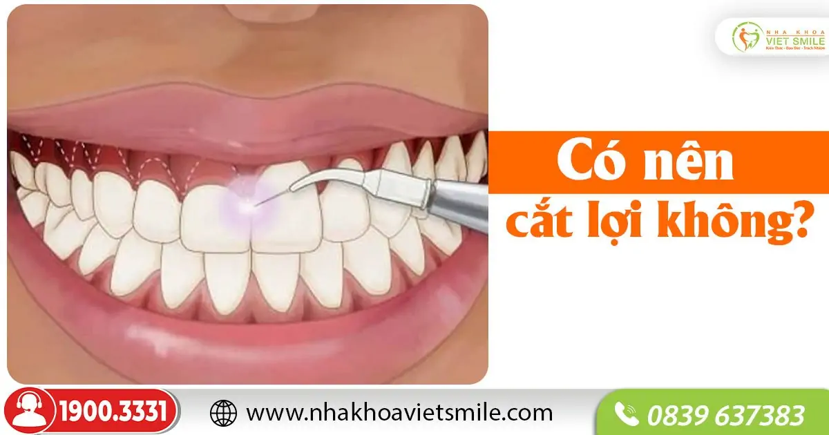 Có nên cắt lợi không?