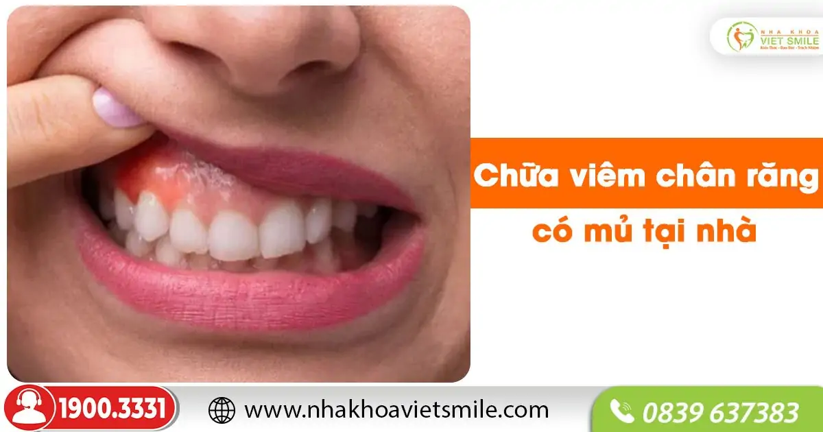 Chữa viêm chân răng có mủ tại nhà